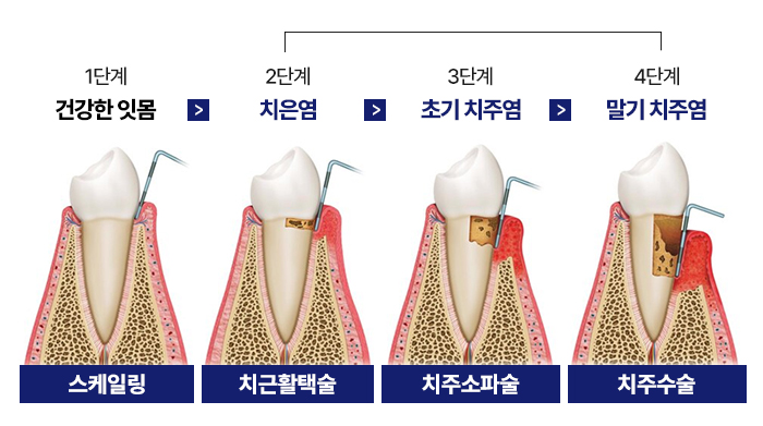 서울대입구역 치과 에서 알려드리는 치주 질환(풍치)의 위험성. 관련 이미지 4