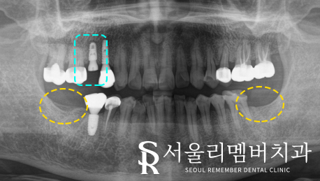 신길동 치과 임플란트에 대한 여러 소문들, 과연 사실일까? 관련 이미지 3