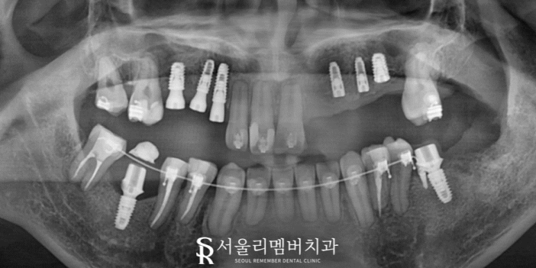 임플란트와 치아교정, 동시에 치료받을 수 있을까요? 남성역 서울 리멤버 치과 관련 이미지 6