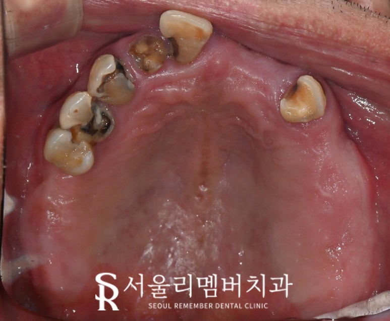 서울대입구역 치과 에서 안전하고 신속 정확하게 발치 후 전악 임플란트 식립한 케이스 관련 이미지 2