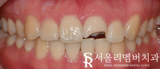 신길동 치과 부러진 앞니, 신경치료로 티 안 나게 개선 완료! 관련 이미지 1