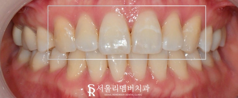 신림역 치과 상악 6전치 리얼네이트 초기 충치 화이트스팟 반점치 라미네이트로 우식 제거 후 보철 수복 과정 관련 이미지 3