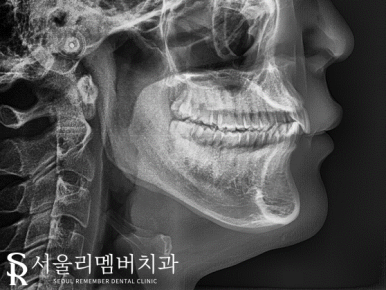 상도동치과 에서 발치 없이 깊게 물리는 과개교합 및 2급 부정교합 개선! 관련 이미지 3
