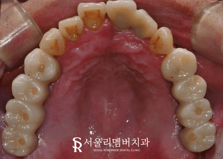 서울대입구역 치과 발치 즉시 다수 네비게이션 임플란트 식립 결과는? 관련 이미지 4
