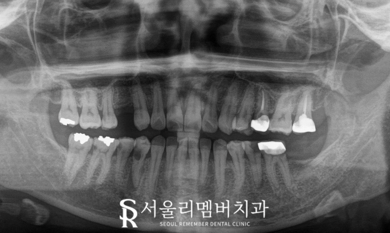 신림 치과 신경치료와 임플란트 어떤 기준으로 결정하게 되는지 궁금하다면 <클릭> 관련 이미지 2
