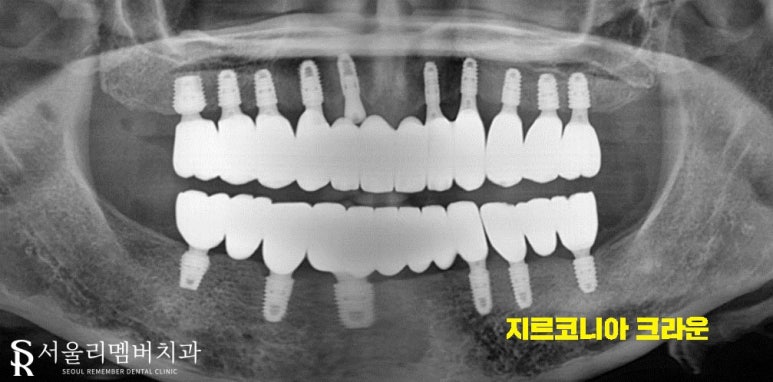 텅텅 여기저기 빠져버린 치아들, 이젠 음식을 씹을 수도 없어요.. 어떡하죠? 서울대입구역 리멤버 치과 관련 이미지 7