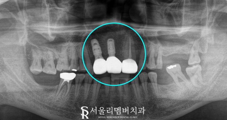 서울대입구 치과 환한 웃음을 되찾는 여정: 앞니 브릿지 탈락부터 임플란트를 통한 새로운 미소까지 관련 이미지 6