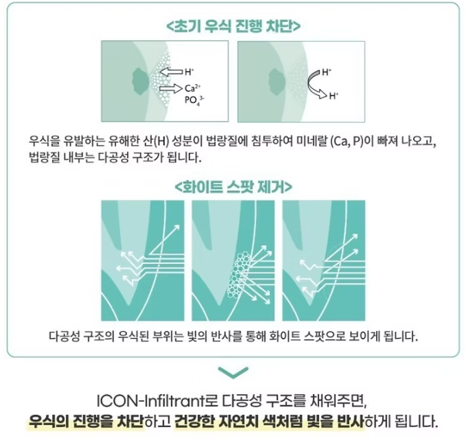 치아의 하얀 반점(화이트 스팟 white spot) 서울대입구역 치과 아이콘 레진으로 무삭제 반점치 충치 치료 관련 이미지 3