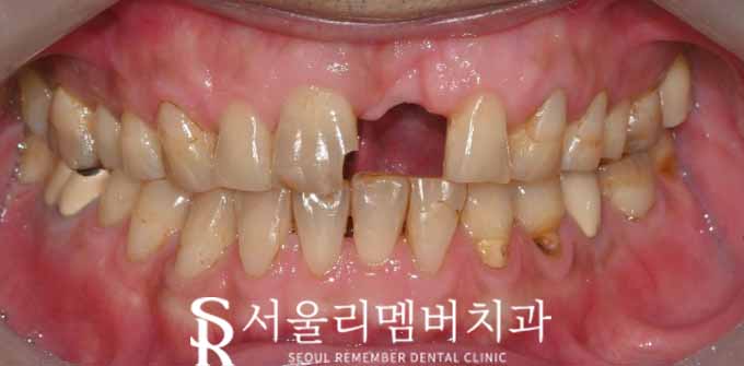 봉천동 치과 에서 신경치료 및 브릿지로 깨진 치아 회복하기 관련 이미지 1