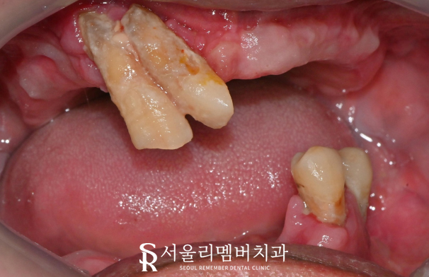 신대방 치과 고난도 전악 임플란트 수술 가능 관련 이미지 3