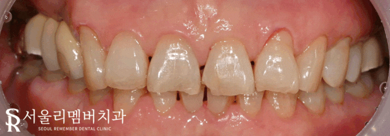 서울대입구역 치과 음식 찌꺼기가 계속 껴요. 관련 이미지 5