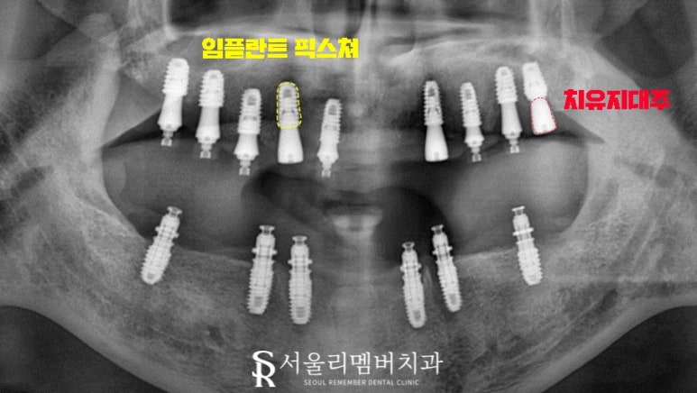 오래된 보철을 방치하면 결국 임플란트 식립밖에 남지 않게 됩니다! 봉천역 리멤버 치과 관련 이미지 5