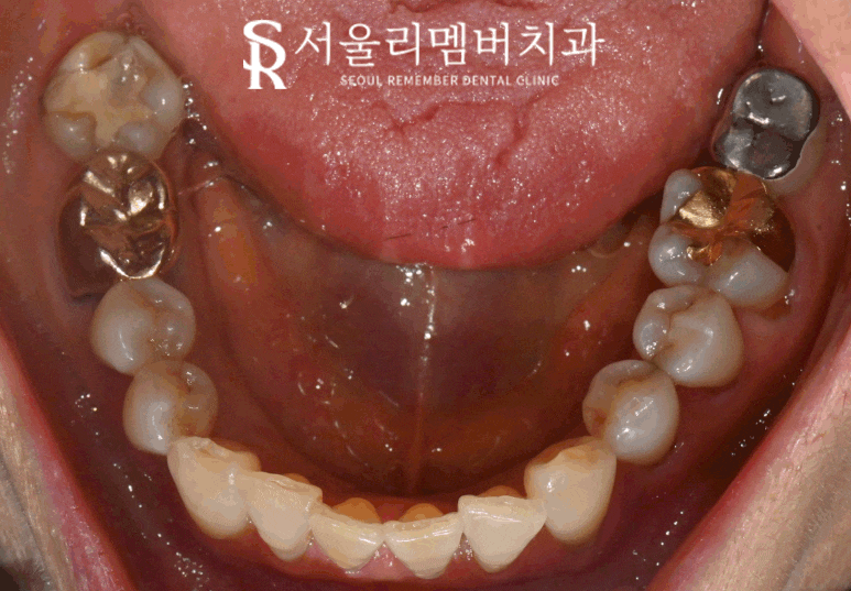 Root Fracture Caused by Secondary Decay Under a Gold Crown, Immediate Implant After Extraction at Sadang Station Dental Clinic image 2