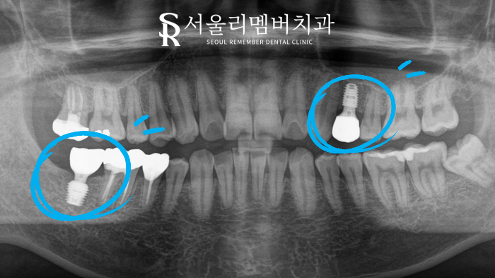 치아 상실로 내원해주셨던 분, 트라우마 극복 후 임플란트 식립 신길동 치과 관련 이미지 2