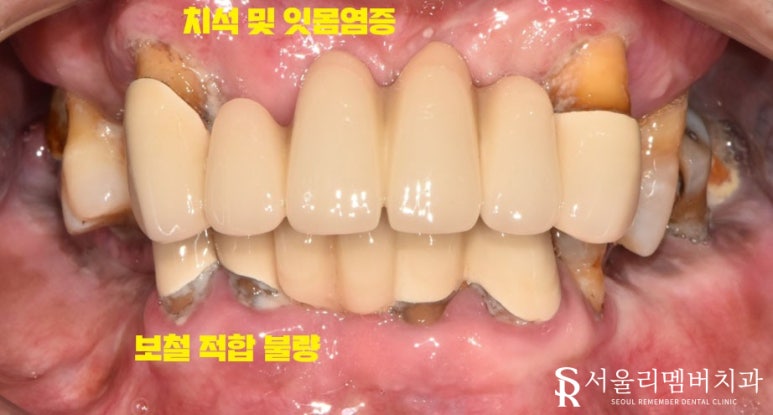 오래된 보철을 방치하면 결국 임플란트 식립밖에 남지 않게 됩니다! 봉천역 리멤버 치과 관련 이미지 1