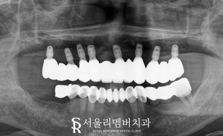 서울대입구역 치과 대표원장이 직접 봐드리는 무치악 환자 전체 임플란트 치료 케이스 관련 이미지 4