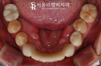 치아 빠지고 흔들리는 어금니와 치주 질환으로 통증 생긴 구강, 관악구 치과 상악 전체 임플란트 및 하악 신경치료 크라운 진행 과정 관련 이미지 8