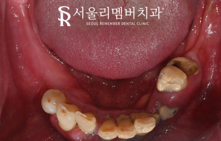 무너진 구강 환경 서울대입구역 치과 에서 편하게 전체 임플란트 치료한 사례 관련 이미지 2
