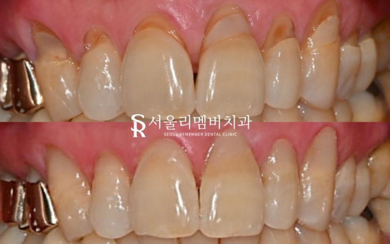 찌릿한 잇몸 패임, 서울대입구역치과 에서 티 안 나게 한 번에! 관련 이미지 3