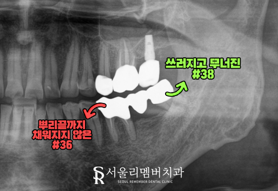 제 기능하지 못하는 오래된 브릿지 보철 제거 후 재신경치료와 임플란트 로 어금니 통증 해결 서울대입구역 치과 관련 이미지 1