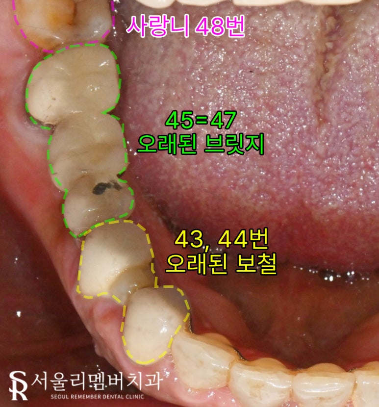 오래된 브릿지와 크라운 보철 임플란트 교체 및 사랑니 발치까지 신대방 치과 관련 이미지 2
