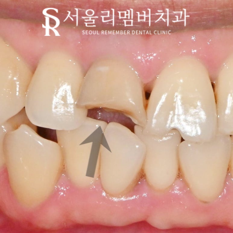 사당 치과 치수 침범 치관 파절로 부러진 앞니 당일 신경치료 후 크라운 관련 이미지 4