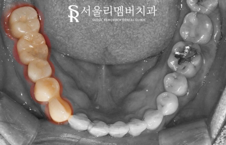 오래된 브릿지와 크라운 보철 임플란트 교체 및 사랑니 발치까지 신대방 치과 관련 이미지 5