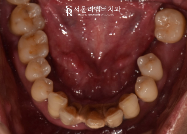 치석이 발치로 이어질 수 있다는 말, 사실일까요?! 봉천동 서울 리멤버 치과 관련 이미지 3