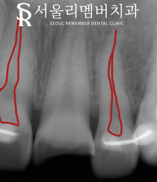 신길동 치과 부러진 앞니, 신경치료로 티 안 나게 개선 완료! 관련 이미지 2