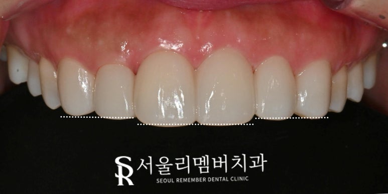 낙성대 치과 앞니 틀어짐 하악 전치 측절치 결손 라미네이트로 공간 닫기 성공 관련 이미지 8