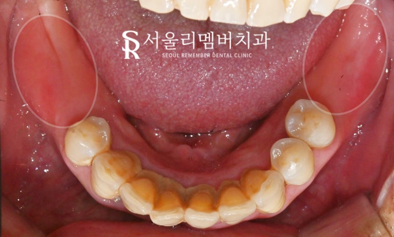 해외 거주하는 한국인, 임플란트 치료는 국내에서 받고 싶다면? 상도동 치과 수술 계획 및 과정 관련 이미지 3
