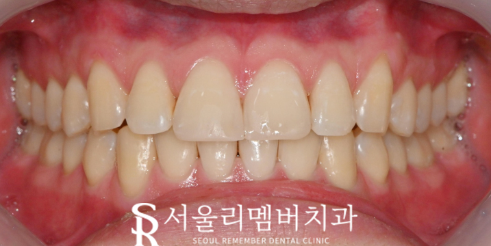 앞니 끝 깨짐 치료, 낙성대 치과 티 안 나는 레진으로 수복하기 관련 이미지 2