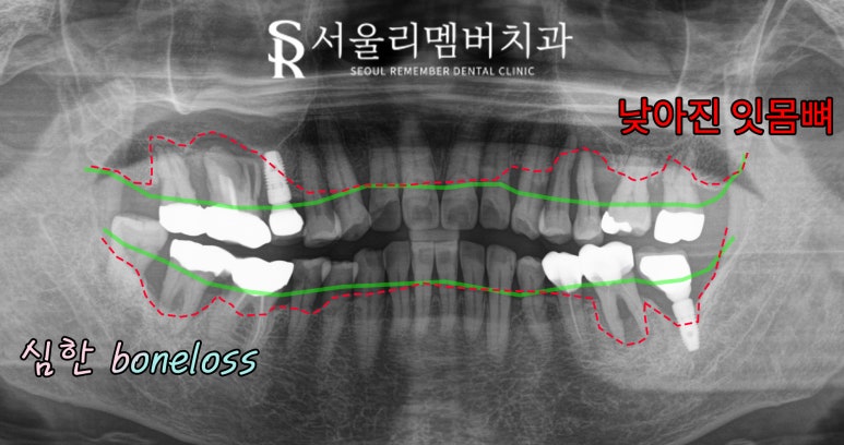 잇몸뼈 녹아버린 치아, 발치 후 그다음은? 사당역 치과 임플란트 관련 이미지 3