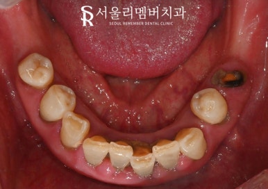 사당 치과 하악 전치 신경치료 브릿지로 살리고 나머지 임플란트로 재건한 전악 증례 관련 이미지 4