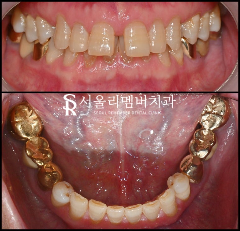 "오래된 크라운 있는 쪽으로 아파서 밥을 못 먹어요." 보라매 치과 임플란트 및 신경치료 후기 관련 이미지 1