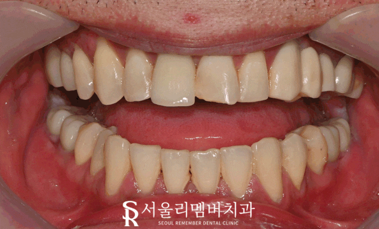 봉천동 치과 앞니 파절 응급 상황에서도 당일 치료 가능한 레진 수복 (해외 거주자도 가능) 관련 이미지 1