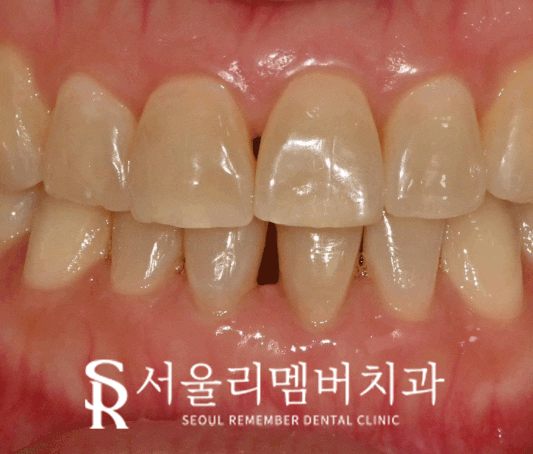 윗니 말고 아랫니! 사당 치과 아래 앞니 하악 전치 벌어진 공간 레진 다이아스태마(Diastema) 관련 이미지 3