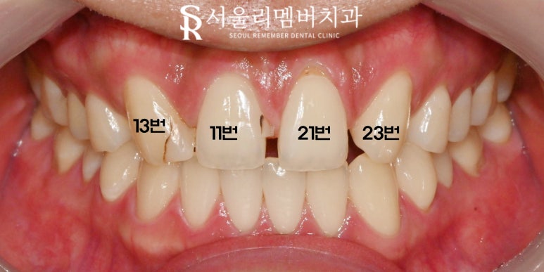 서울대입구 치과 결손된 앞니 자연스러운 라미 리얼네이트로 변색 레진과 사이 공간 막을 수 있다면 관련 이미지 1