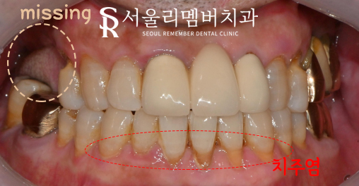 봉천동 치과 임플란트 치료 과정, 어금니가 없어서 식사가 어려워요. 관련 이미지 3