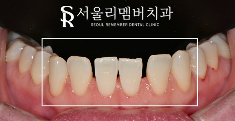 하악 전치 벌어진 공간 스페이스 해소를 위한 아래 앞니 6전치 리얼네이트 라미네이트 케이스 관련 이미지 3