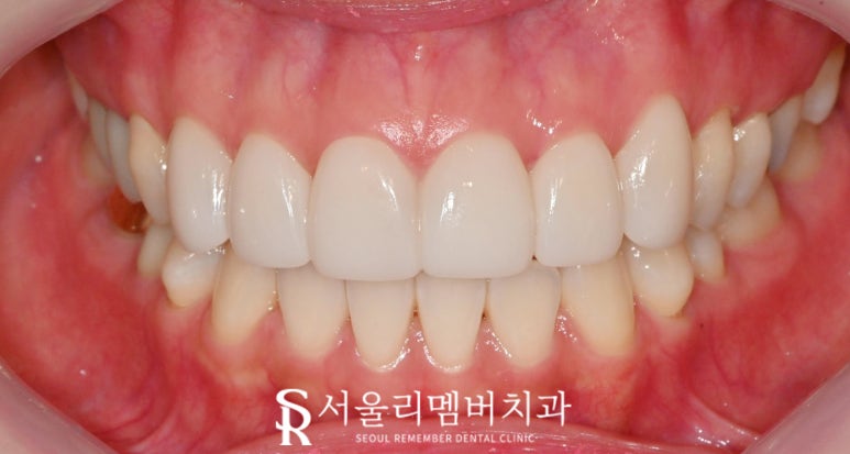 Concerned About the Color and Shape of Your Front Teeth? Seoul National University Station Dental Clinic—Maxillary Six Anterior Veneers Extending to the Canines image 5