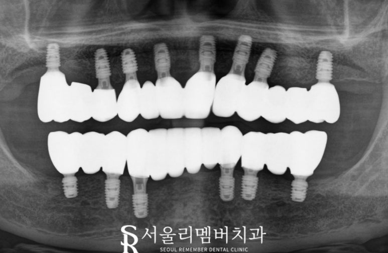 치주염으로 균형이 깨져버린 구강, 신대방 치과 에서 전체 임플란트 수술 증례 관련 이미지 5