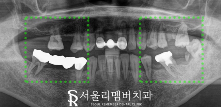 한 번에 많은 치아 치료해야 된다면? 사당역 치과 수면 임플란트 로 편안하게 관련 이미지 5
