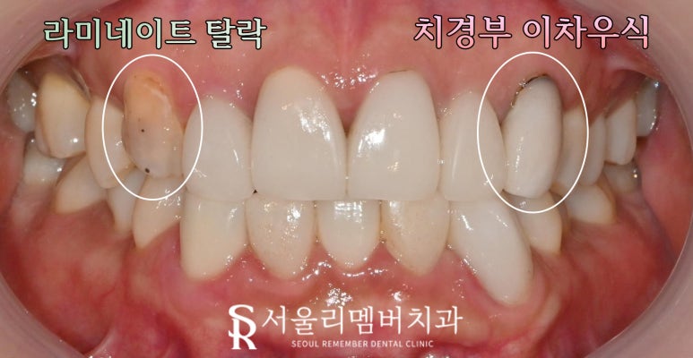 Nakseongdae Dental Clinic: If a front tooth laminate veneer falls off, can’t it just be reattached? Anterior crowns and Realnate re-prosthetics image 1