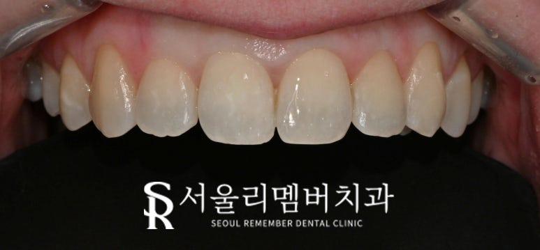 앞니에 생긴 하얀 점? 신림 치과 전치부 화이트스팟(white spot) 레진 당일 치료 관련 이미지 3