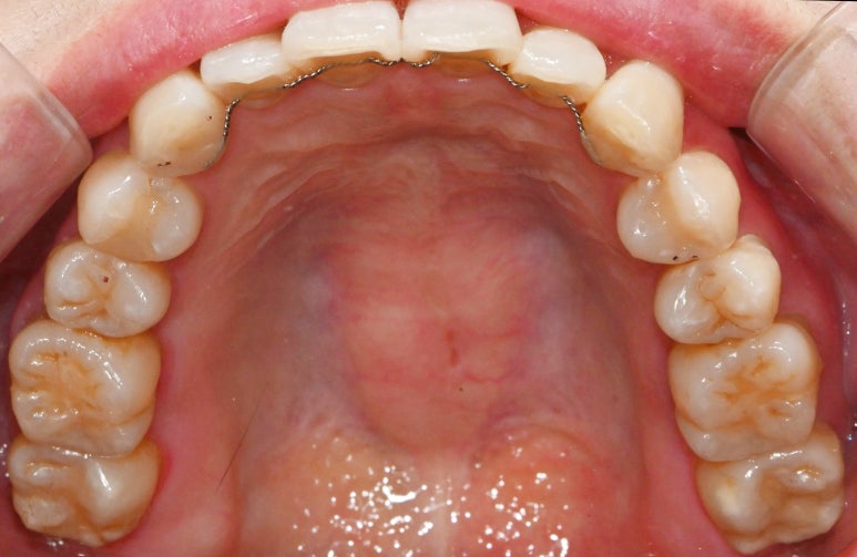 선천적 영구치 결손으로 남아있는 만기 잔존 유치, 서울대입구역 교정 치과 에서 투명 인비절라인 & 임플란트 케이스 관련 이미지 10