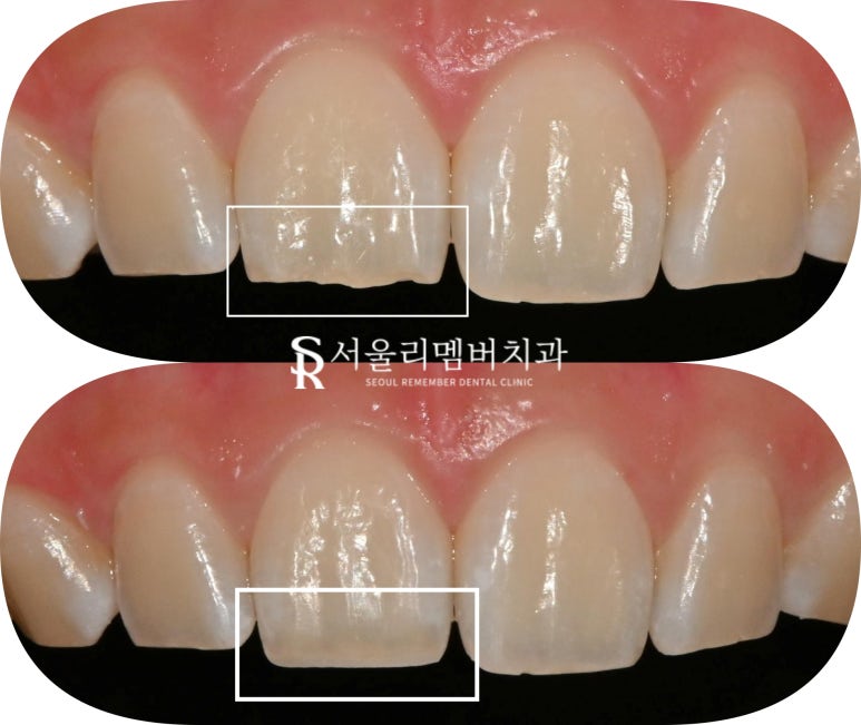 신림역 치과 앞니 끝부분 깨짐 절단연 파절 레진으로 티 안 나게 하루 만에 당일 치료 관련 이미지 3