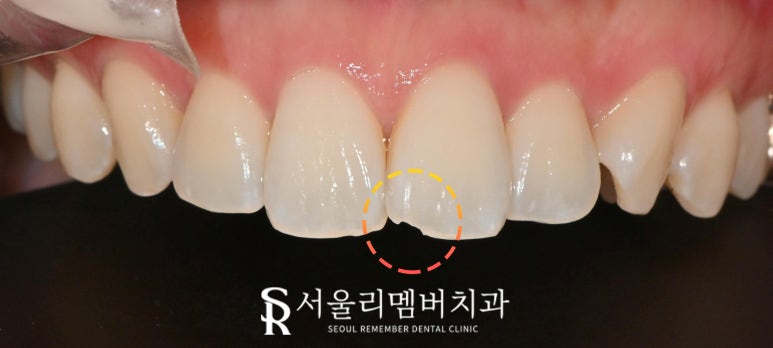 앞니 끝 살짝 깨짐, 보라매 치과 당일 레진으로 비용 부담 없이 1회 내원만에 복원 가능할까? 관련 이미지 3