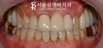 봉천동 치과 임플란트 치료 과정, 어금니가 없어서 식사가 어려워요. 관련 이미지 10