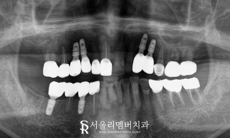 사당역 치과 충치, 치아 흔들림, 파절, 결손, 염증.. 다수의 복합 문제 생겼다면 임플란트 신경치료 크라운 과정 관련 이미지 9